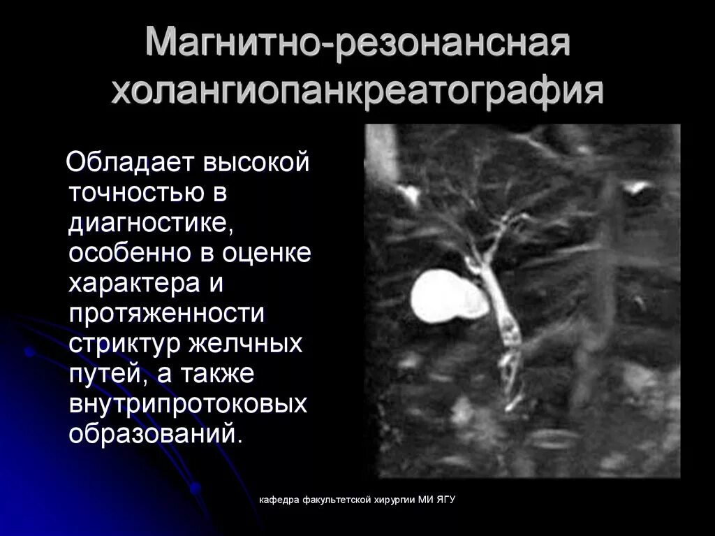 Магнитно-резонансная холангиопанкреатография при ЖКБ. МРХПГ желчных протоков. МРХПГ поджелудочной железы.