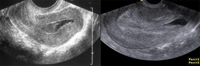 Восстановление после выскабливания. Замершая беременность УЗИ. УЗИ матки после медикаментозного прерывания. УЗИ после выскабливания замершей беременности. Замерзшая беременность на УЗИ.