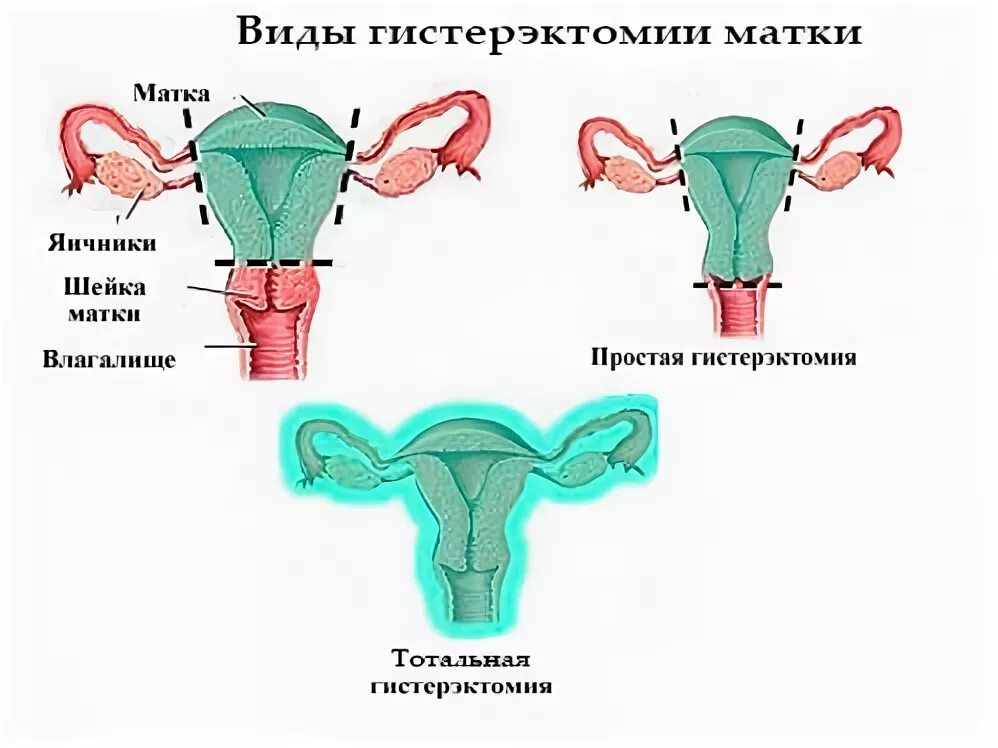 Экстирпация матки схема. Экстирпация матки культя влагалища. Гистерэктомия матки с придатками. Гистерэктомия что это такое простыми словами