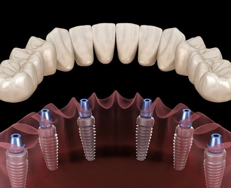 All on 6 цена. Дентальные имплантаты all on 6. Дентальные имплантаты на 6+6. Мостовидный протез на 6 имплантах. Имплантат Paltop.