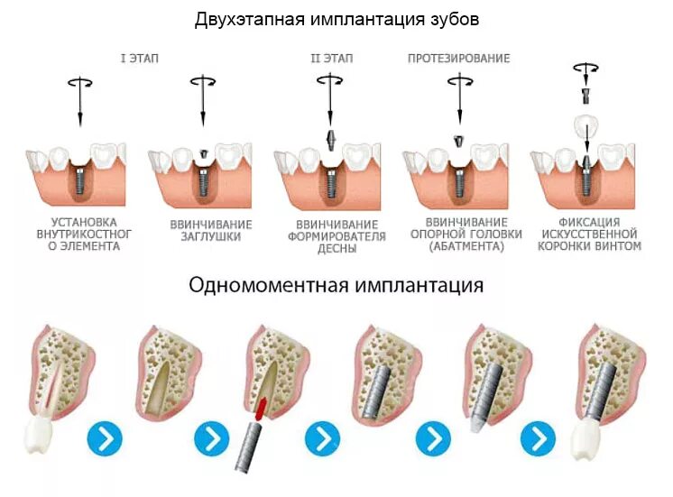 Пины в стоматологии