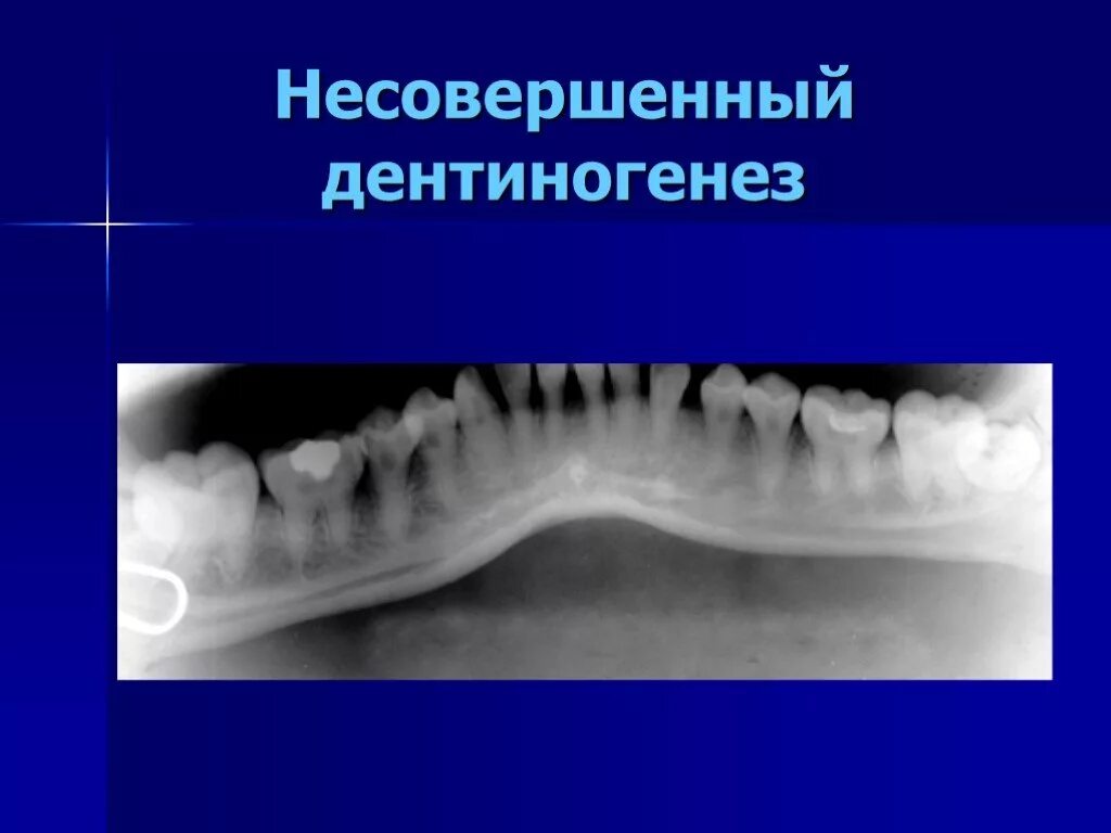 Патология твердых тканей. Дисплазия Стентона Капдепона. Несовершенный дентиногенез 1 типа. Наследственный несовершенный амелогенез. Несовершенный дентиногенез 3 типа.