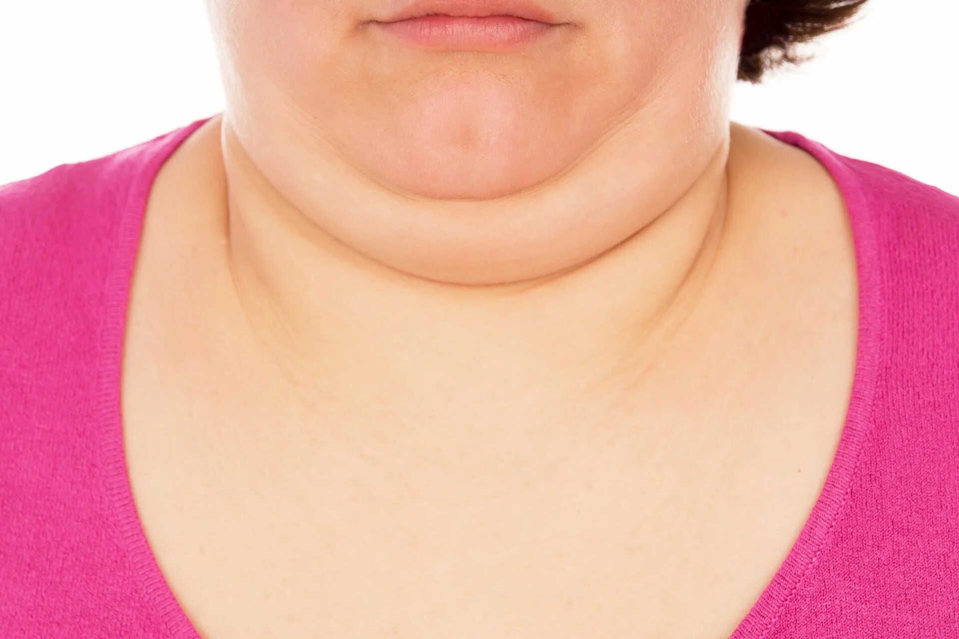 Искривление подбородка. Подбородок у новорожденного. Подбородок у новорожденного. Липосакция подбородка схема. Женщина со вторым подбородком.