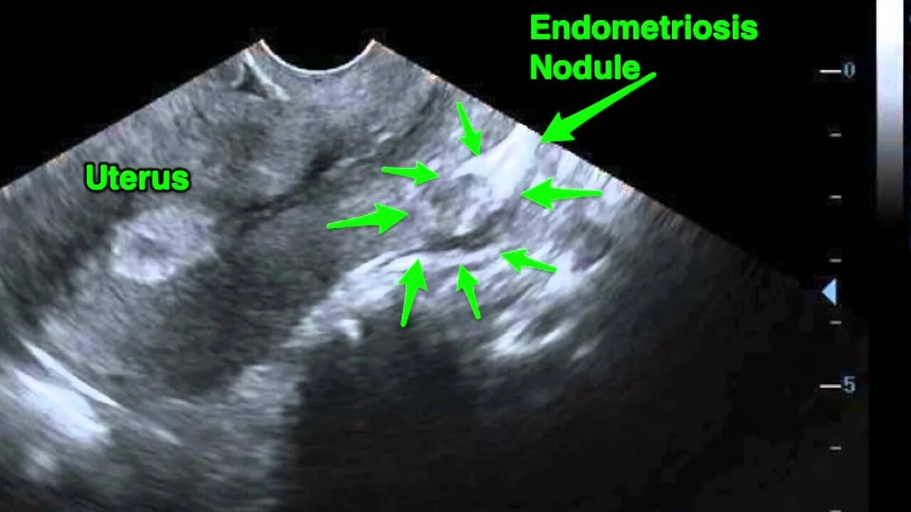 УЗИ картина внутреннего эндометриоза. Наружный эндометриоз на УЗИ. Узловой эндометриоз по УЗИ. Эндометриоз виден на узи