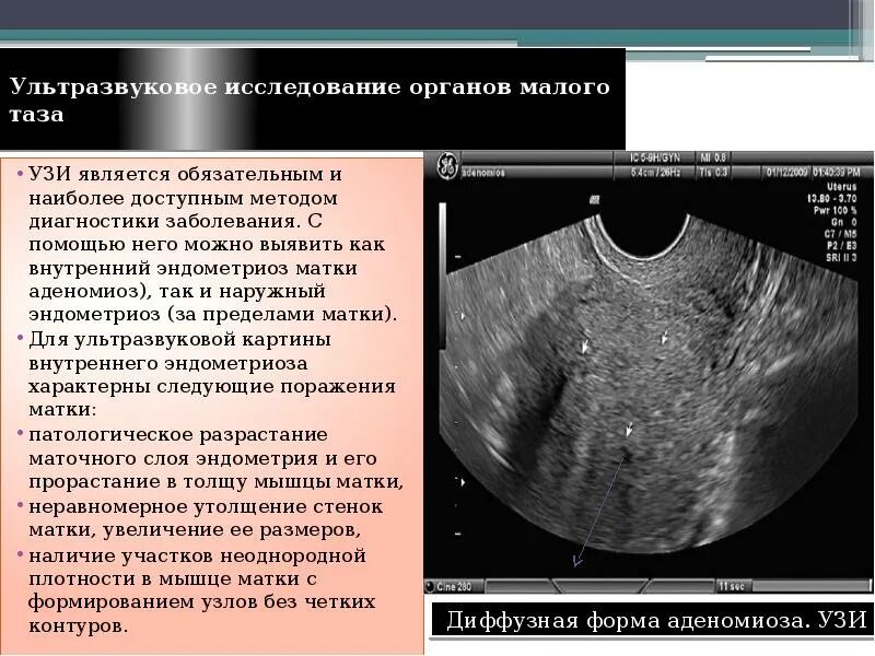 Узлы эндометрия. УЗИ критерии внутреннего эндометриоза. Узловая форма аденомиоза по УЗИ. Аденомиоз Узловая форма УЗИ.