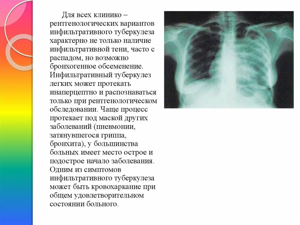 Инфильтративный туберкулез. Инфильтративный туберкулез Рентгенологи. Для инфильтративного туберкулеза легких характерно. Инфильтративный туберкулез легких в фазе распада и обсеменения. Инфильтративный распад легких