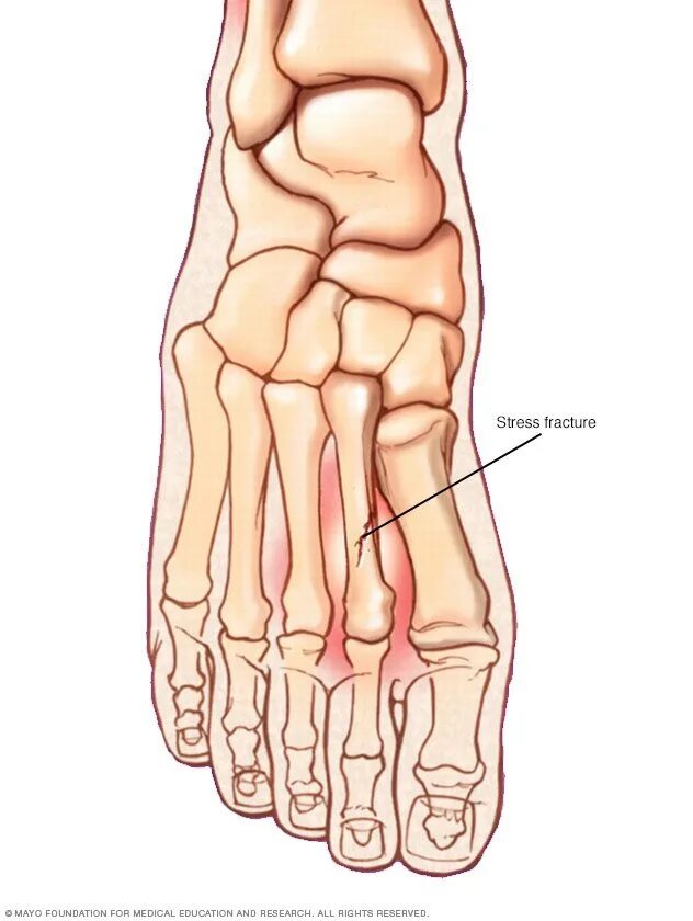 Трещина кости на ноге. Стрессовый перелом плюсневой кости. Стресс перелом плюсневой кости стопы. 5 Плюсневая кость стопы.