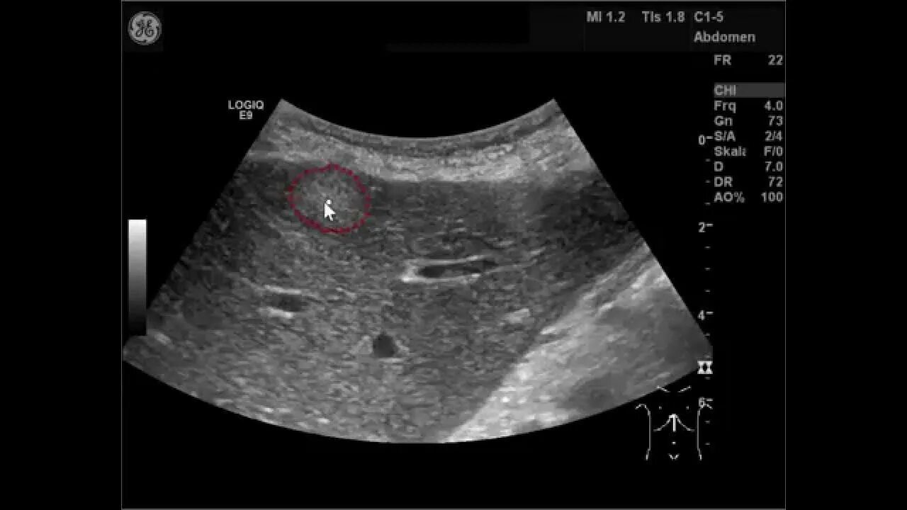 Круглая связка печени на УЗИ. Видна ли опухоль на узи