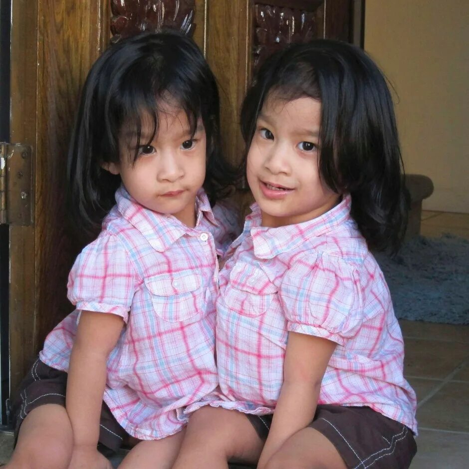 Близнец обижен. Фото сиамских близнецов. Сиамские Близнецы разделенные.