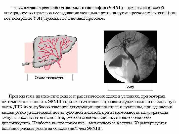 Чрескожное-транспеченочное дренирование (для снятия гипертензии). Дренирование желчных протоков. Дренирование желчных протоков УЗИ. Чрескожная чреспеченочная холангиостомия. Кролог