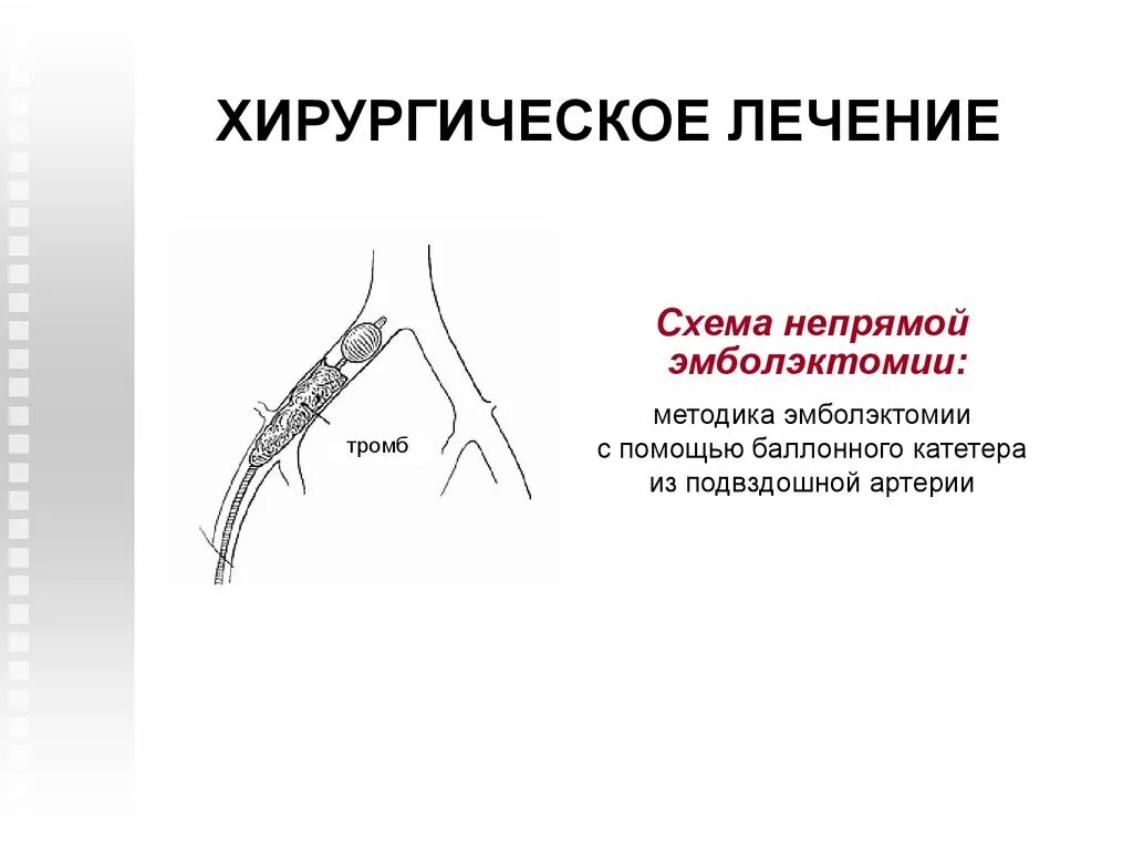 Тромбозы и эмболии артерий. Тромбоэмболия бедренной артерии. Патогенез эмболии бедренной артерии. Эмболия бедренной и подвздошной артерии. Тромбоэмболия сосудов нижних конечностей.