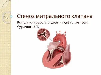 Комбинированный митральный порок