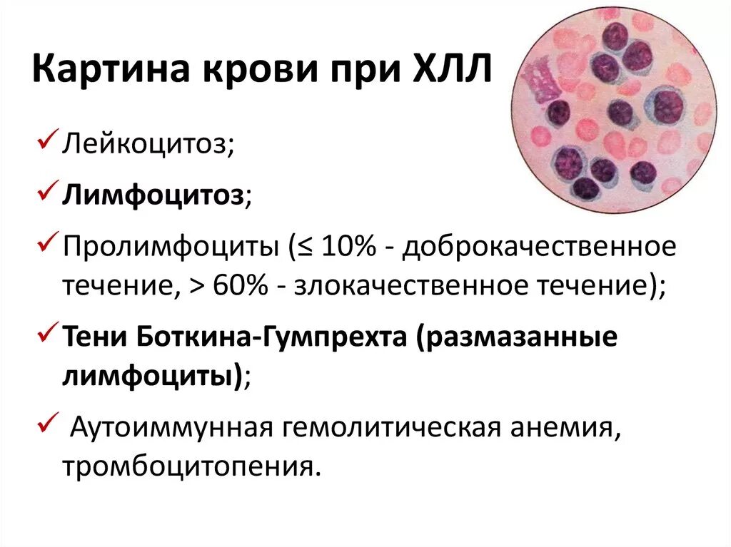 Культивирование лимфоцитов периферической крови. Хронический лимфоцитарный лейкоз картина крови. Картина крови при хроническом лимфолейкозе. Острый лимфобластный лейкоз тени Боткина Гумпрехта.