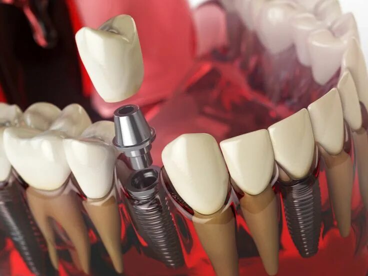 Имплант lenmiriot. Дентальный имплантат. Имплант dentium superline. Иплант. Коронка на имплантат osstem.