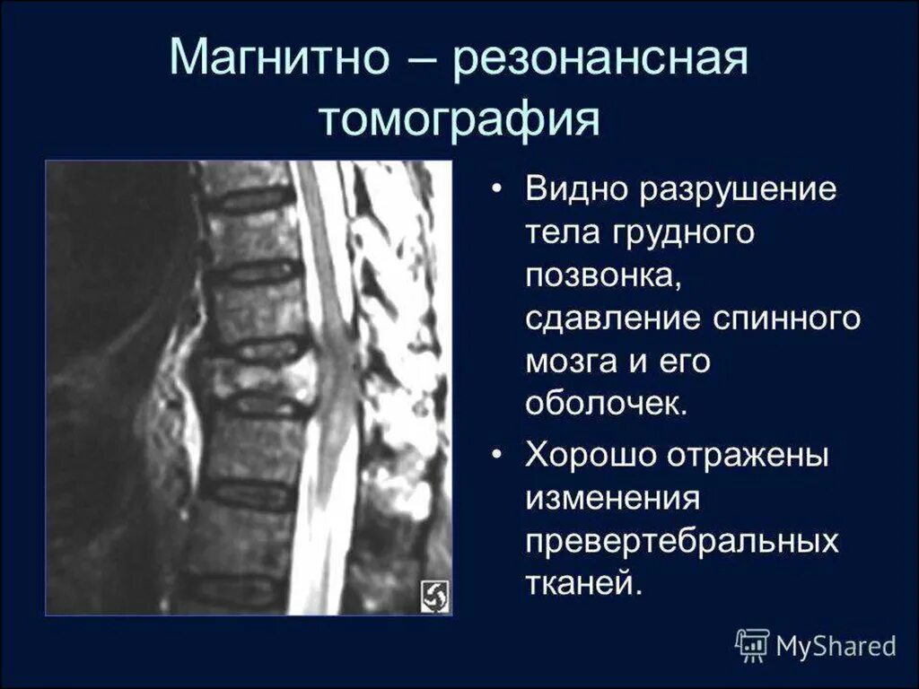 Спинномозговая грыжа рентгенография. Сдавливание спинного мозга. Лучевая диагностика повреждений позвоночника. Сдавление спинного мозга мрт.