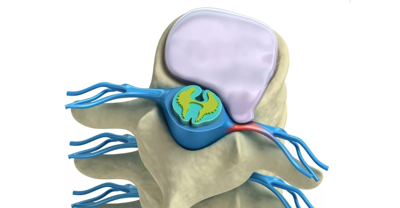 Болит ли протрузия. Протрузия мигательной мембраны. Протрузии шейного отдела позвоночника. Протрузия ортопедические принадлежности.