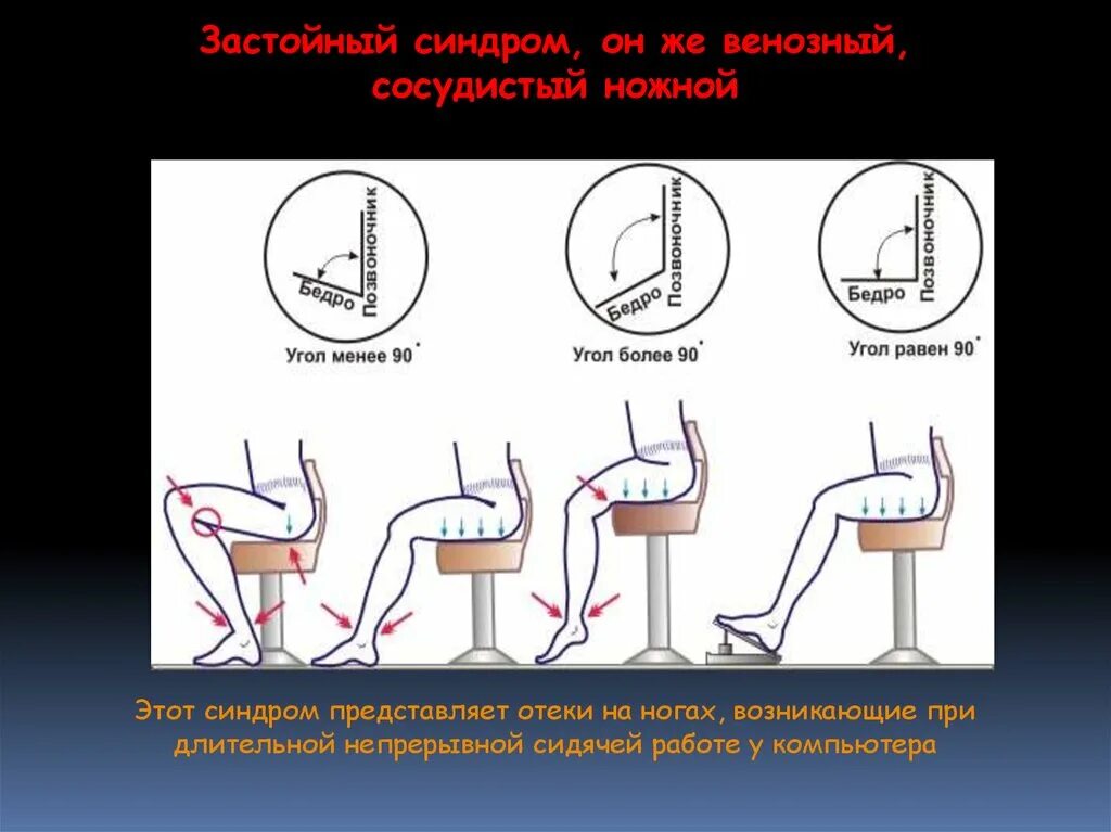 Отек ног от сидячей работы