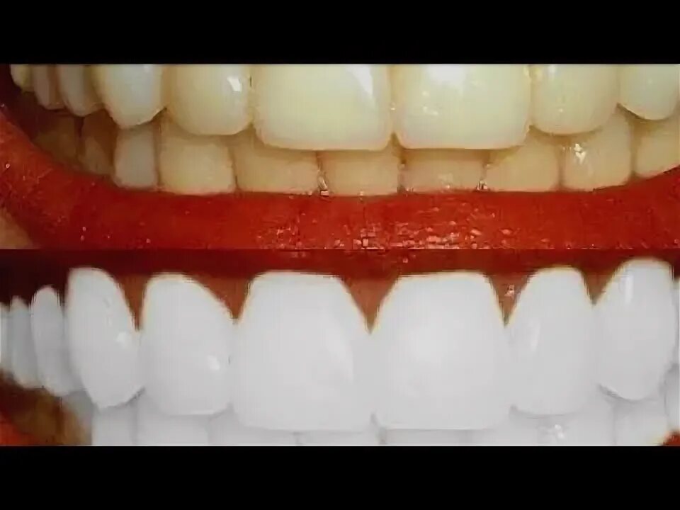 Почему на зубах желтый как паутинка. Зубы отбелились пятнами. Пришеечный кариес белый. Зубы стали белыми. Зубы стали белыми.