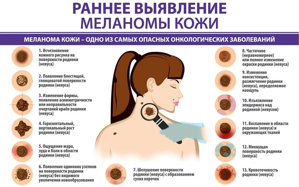 К какому врачу идти если сильный. Раковые заболевания кожи. Заболевание кожи меланома.