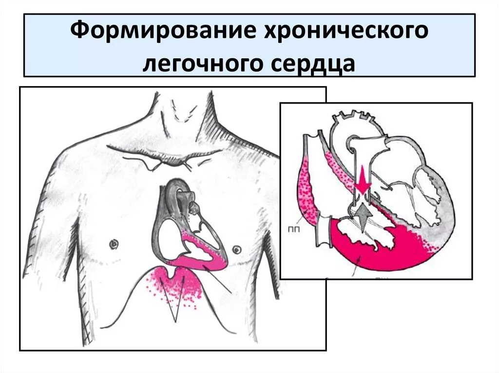 Хроническое легочное сердце. Хроническое легочное сердце патанатомия. Хронич легочное сердце. Хроническое лёгочное се. Хроническая легочно сердечная недостаточность