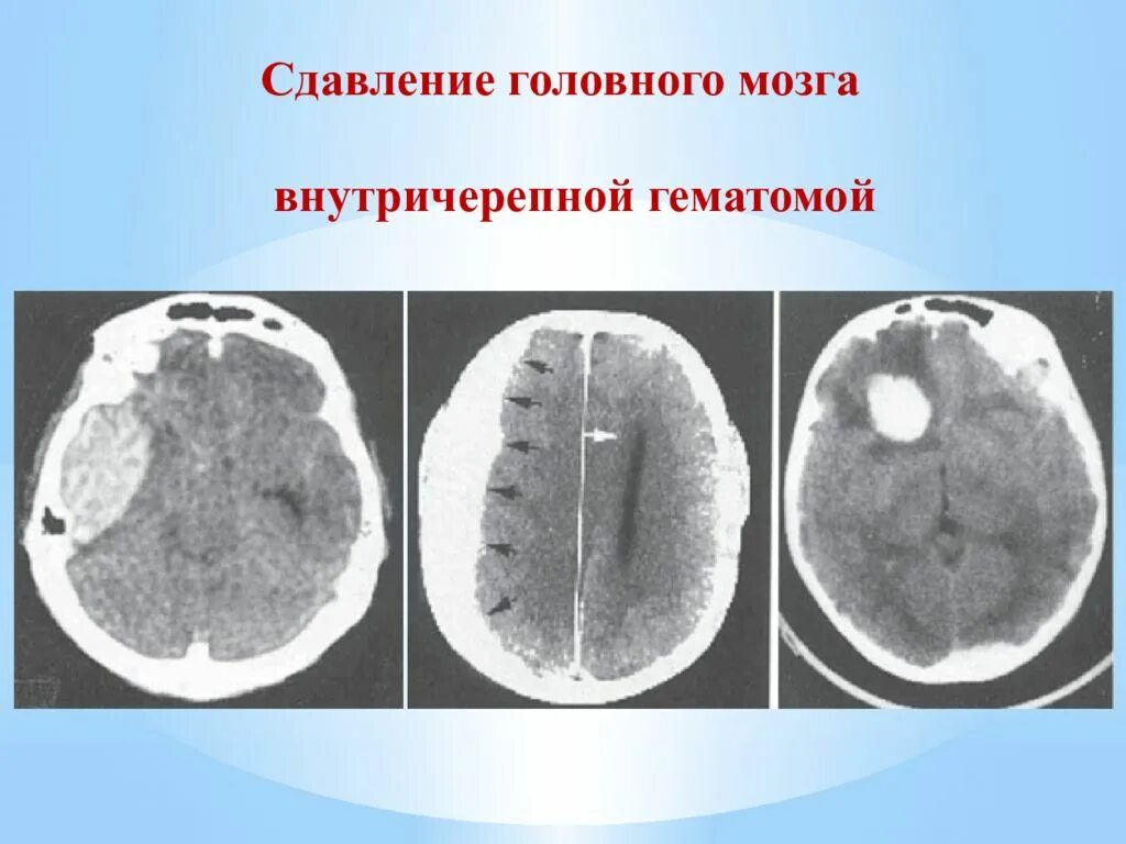 Открытая травма мозга. Сдавление головного мозга внутричерепными гематомами. Черепно-мозговая травма сдавление головного мозга. Сдавление головного мозга кт.