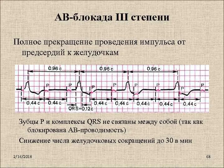 Блокада на первом. Полная атриовентрикулярная блокада 3 степени на ЭКГ. ЭКГ АВ блокада 1. АВ блокада 3 степени на ЭКГ. ЭКГ при АВ блокаде 3 степени.