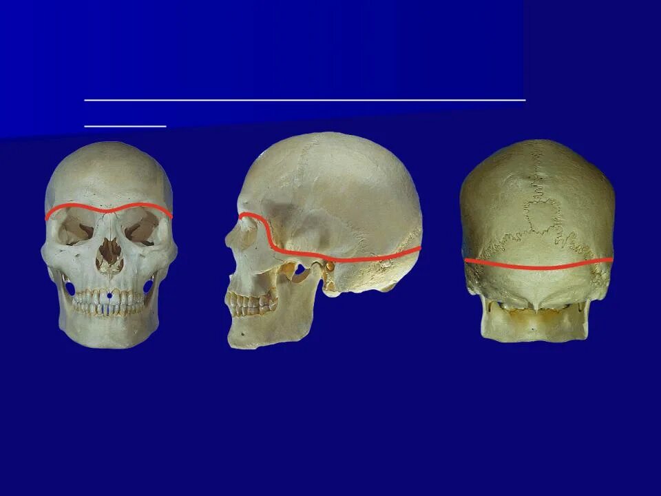 Деформация кости черепа. Основание черепа и свод черепа анатомия. Костный свод и основание черепа. Мозговой череп свод и основание. Граница свода и основания черепа.