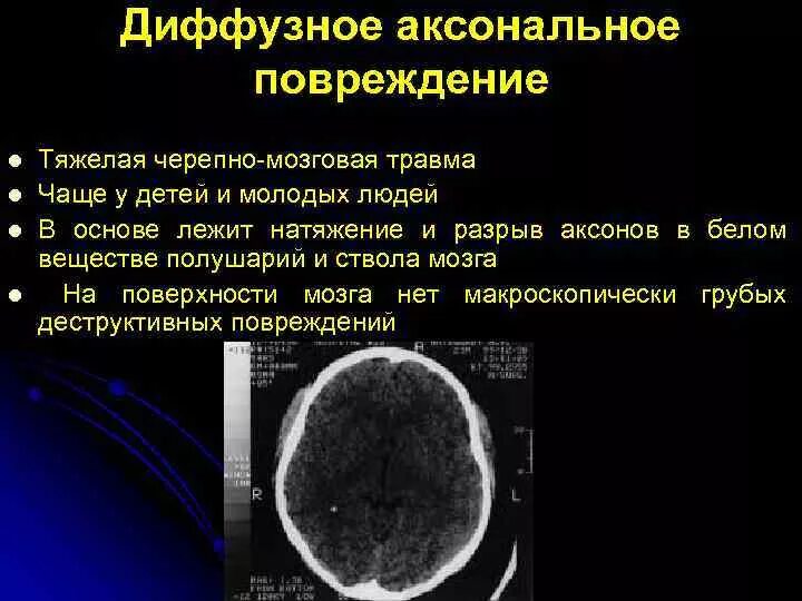 Диффузное аксональное повреждение. Диффузное аксональное повреждение головного мозга. Диффузное аксональное повреждение кт. Диффузное аксональное повреждение мозга кт.