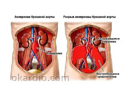 Аневризма брюшной полости