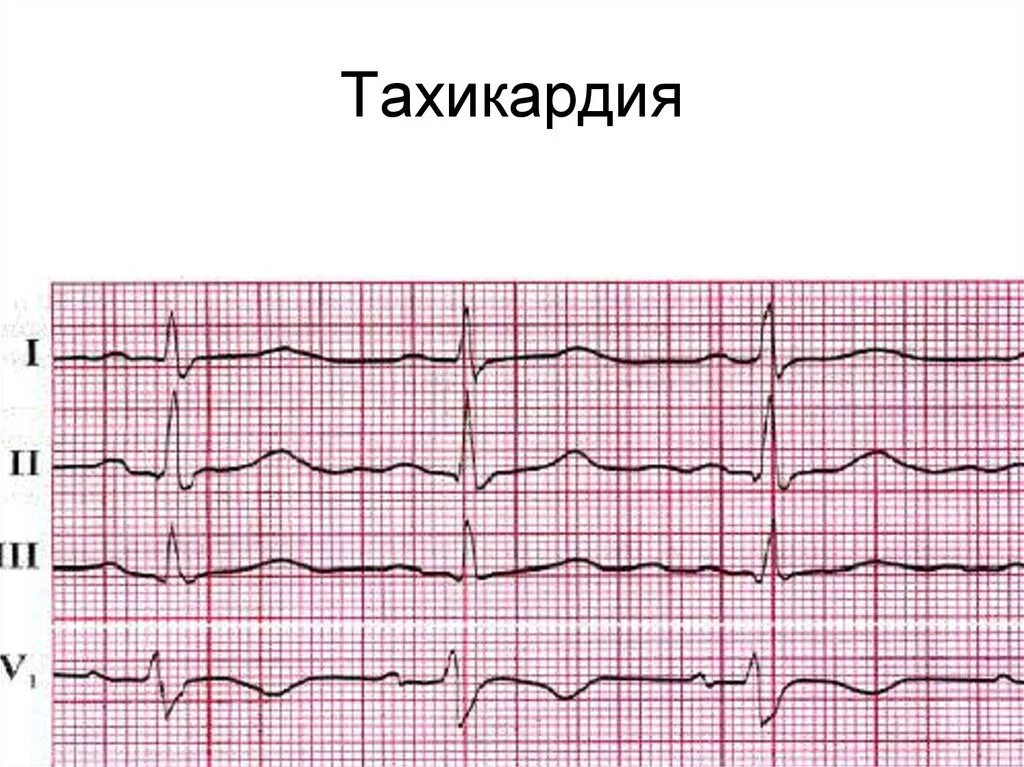 Тахикардия. Тахикардия сердца. Учащённое сердцебиение. ЭКГ сердца.