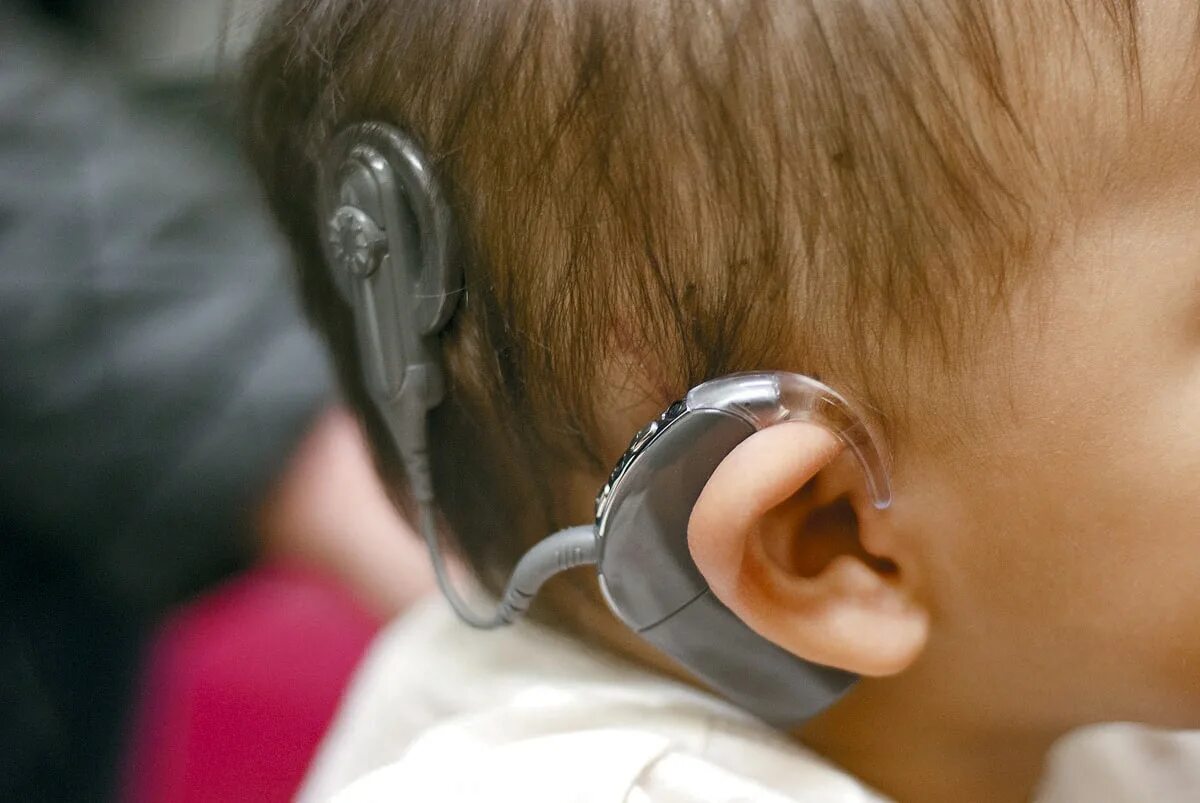 Кохлеарная имплантация Cochlear. Кохлеарный имплант слух. Кохлеарный имплант Кохлер.