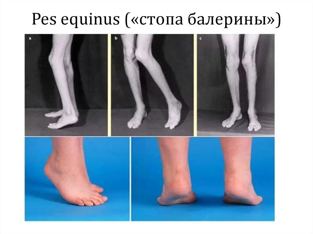 Эквиноварусная деформация стопы. Трансоссальный шов ахиллова сухожилия. Супинация косолапости. Эквинусной деформации стопы. Пронация супинация в голеностопе.