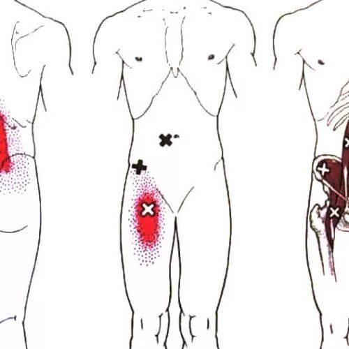 Внутренняя сторона паха. Боль в бедре с внутренней стороны. Мышцы паха. Гидраденит стафилококковый. Треугольник гессельбаха топографическая анатомия.