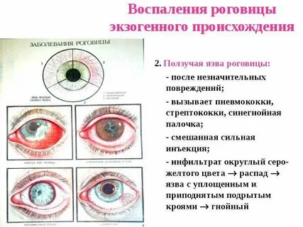 Заболевания слизистой глаз