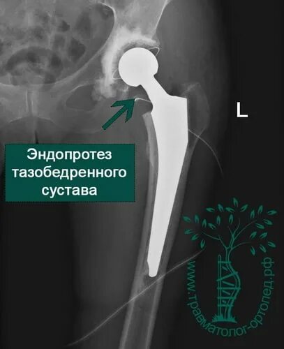 Биполярный эндопротез тазобедренного сустава. Цементная мантия эндопротеза тазобедренного сустава. Эндопротез плечевого сустава. Эндопротез плечевого сустава Тотальный реверсивный.