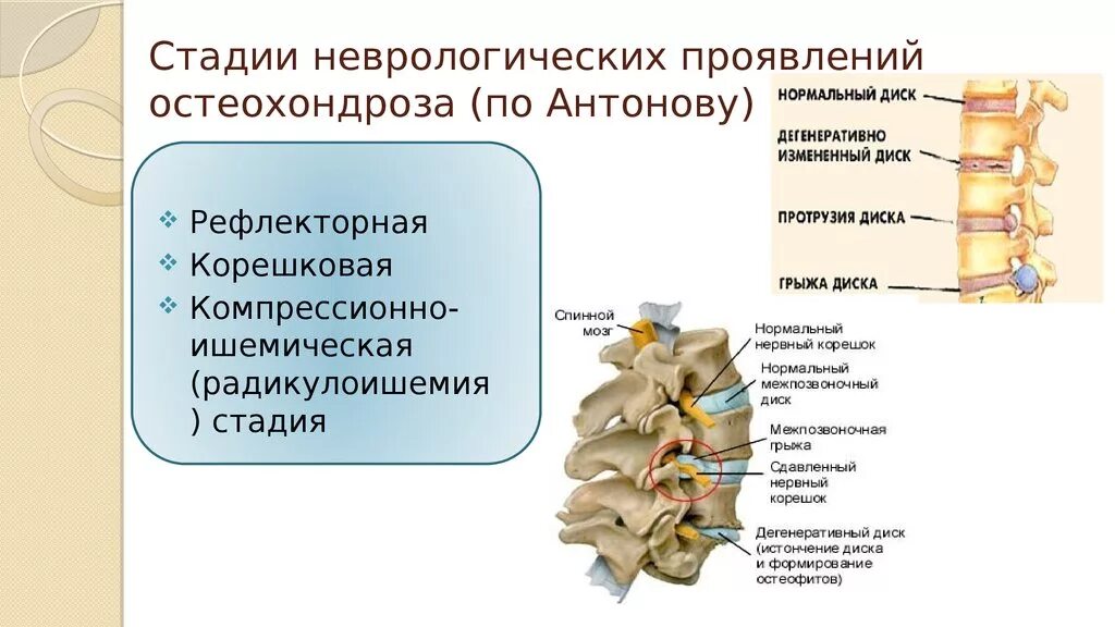 Остеохондроз поясничного отдела позвоночника периоды. Остеохондроз классификация по стадиям. Остеохондроз. Неврологические проявления остеохондроза. Этапы остеохондроза. Неврологические проявления поясничного остеохондроза.