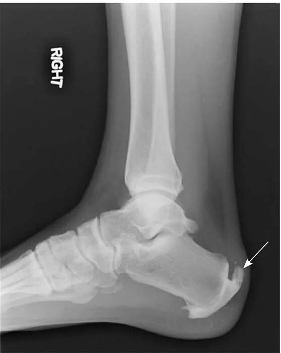 снимок пяточной шпоры на рентгене. тендиноз ахиллова сухожилия мрт. ахиллова пяточная шпора. задняя ахиллова пяточная шпора. плантарный фасциит рентген.