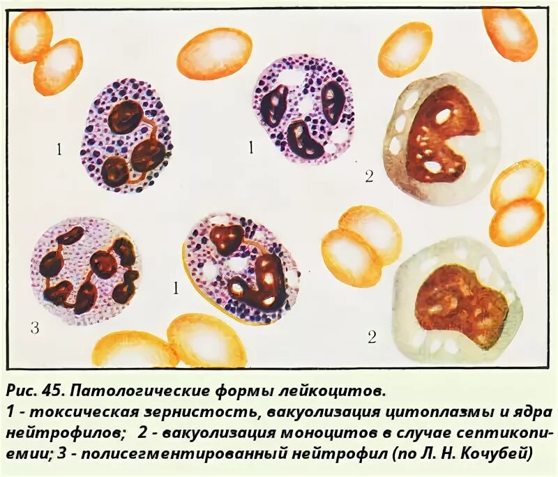 Изменения лейкоцитов в крови. Базофильная зернистость нейтрофилов. Токсическая зернистость нейтрофилов вакуолизация. Токсикогенная зернистость нейтрофилов. Токсическая (токсогенная) зернистость нейтрофилов.