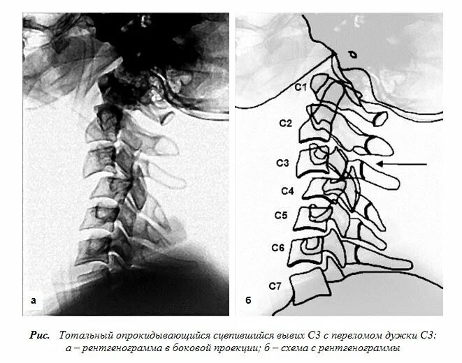 Вывих с2 позвонка рентген. Подвывих с1 шейного позвонка рентген. Шейный отдел позвоночника рентген с1-с2. Подвывих поясничного позвонка рентген. Рентгенография позвоночника в 2 х проекциях