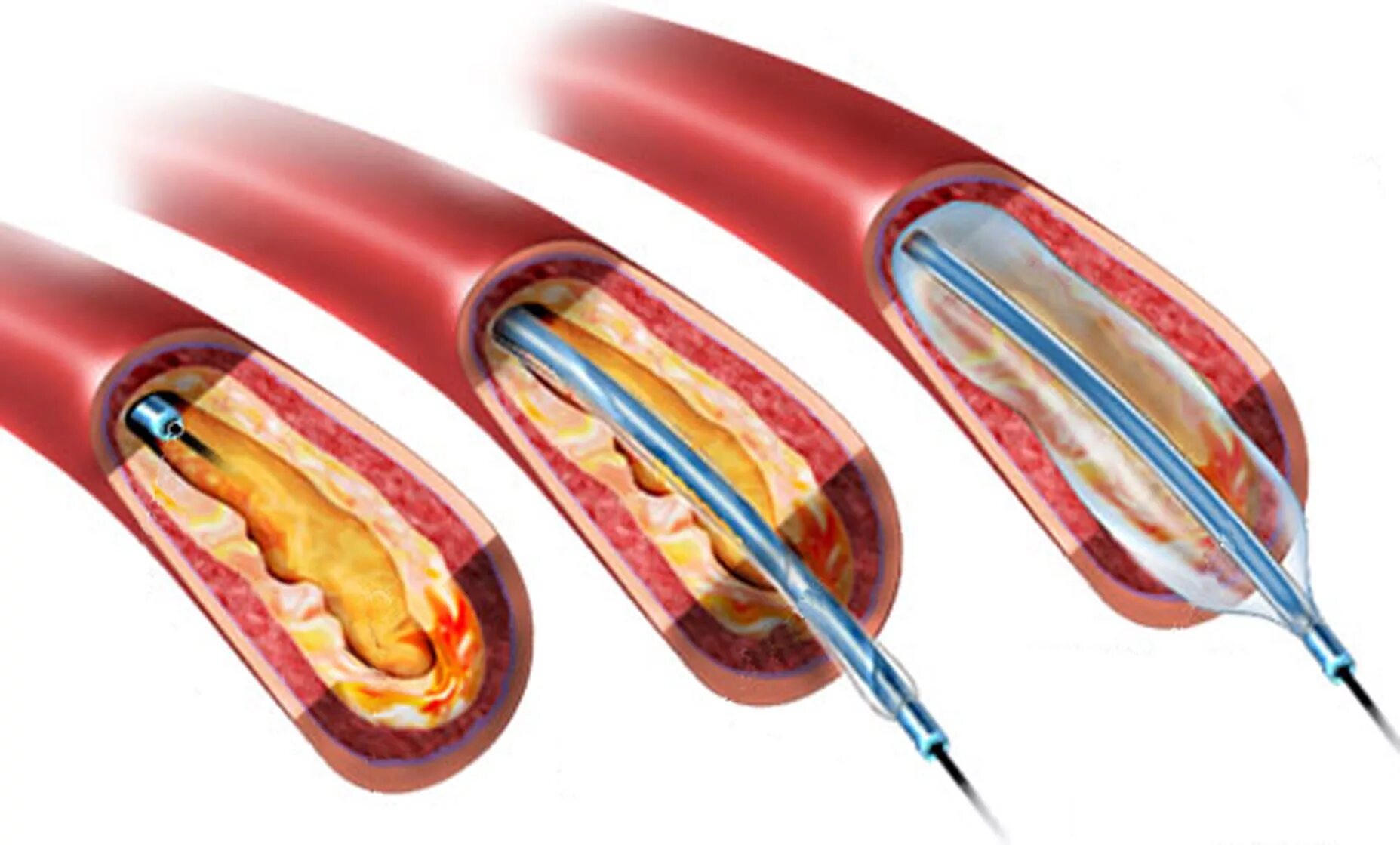 Стенты для сосудов. Эндоваскулярная баллонная ангиопластика. Баллонная коронарная ангиопластика. Баллонная дилатация (баллонная ангиопластика). Стентирование сонойартерии.