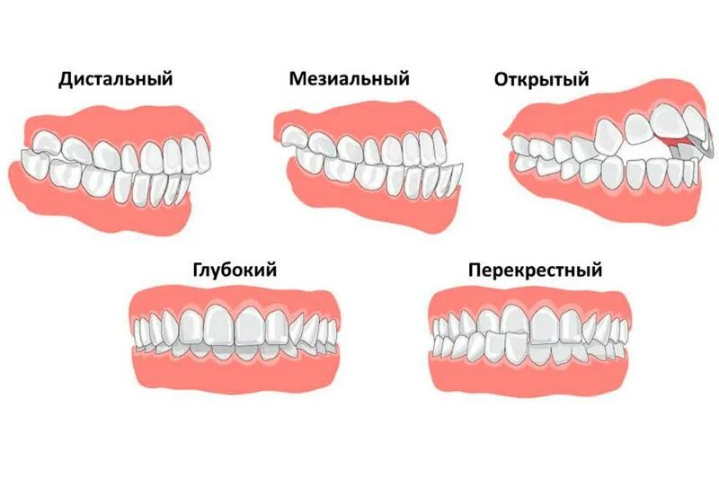 Почему зубы отличаются между собой у разных. Дистальный прикус у ребенка 6 лет. Правильный прикус зубов. Неправильный прикус у ребенка дистальный.
