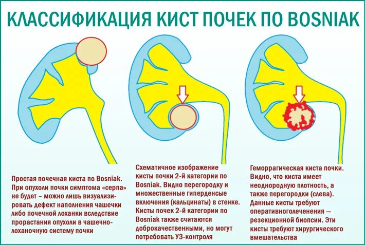 Можно с кистой в баню. Лекарство от кисты почек. Почечная киста лекарства. Препараты для рассасывания кисты почек.