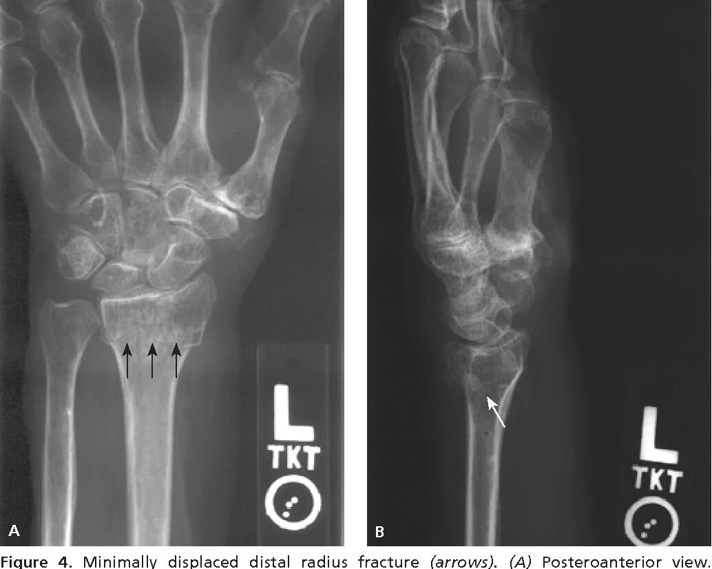 Radius fracture. Radius fracture