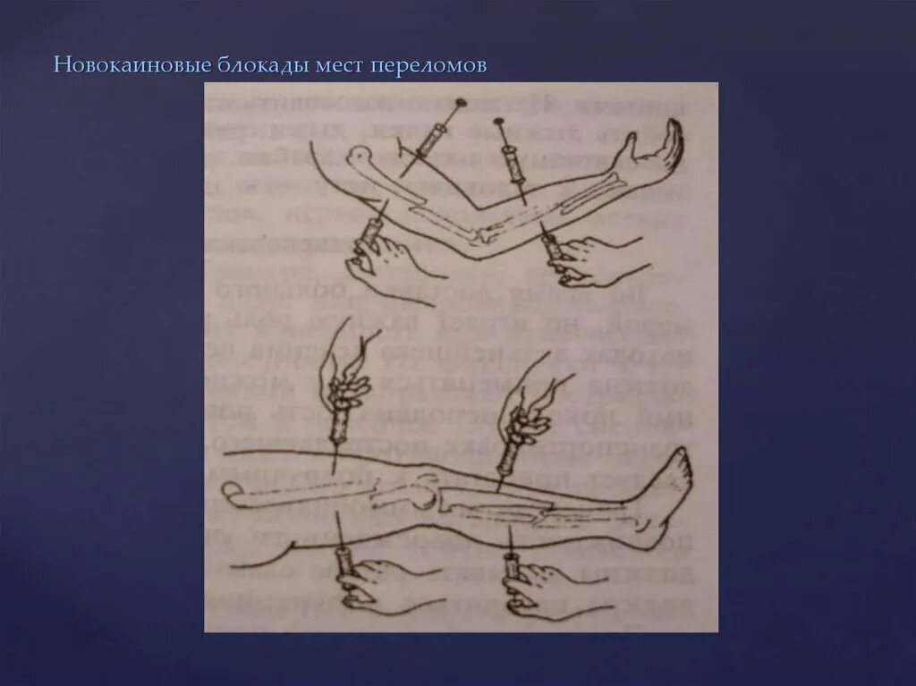Блокада техника выполнения. Проводниковая новокаиновая блокада техника. Проведение внутрикожной новокаиновой блокады. Алгоритм. Блокада места перелома техника выполнения. Новокаиновая блокада при переломе.