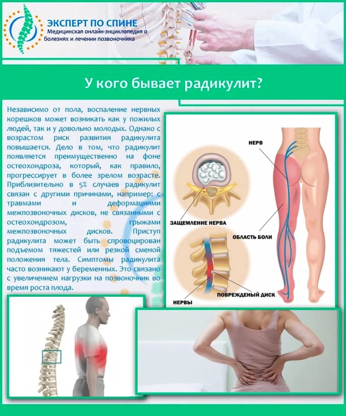 Радикулит боли в пояснице. Заболевание спины поясница. Радикулит поясничный. Пояснично-крестцовый радикулит.