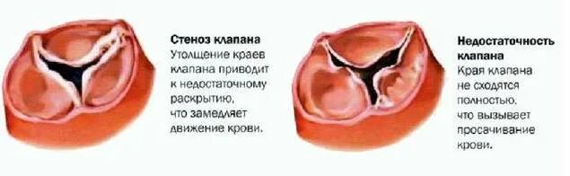 Дегенерация митрального клапана. Стеноз трикуспидального клапана. Недостаточность и стеноз трехстворчатого клапана. Стеноз и недостаточность трикуспидального клапана. Стеноз трехстворчатого клапана сердца.