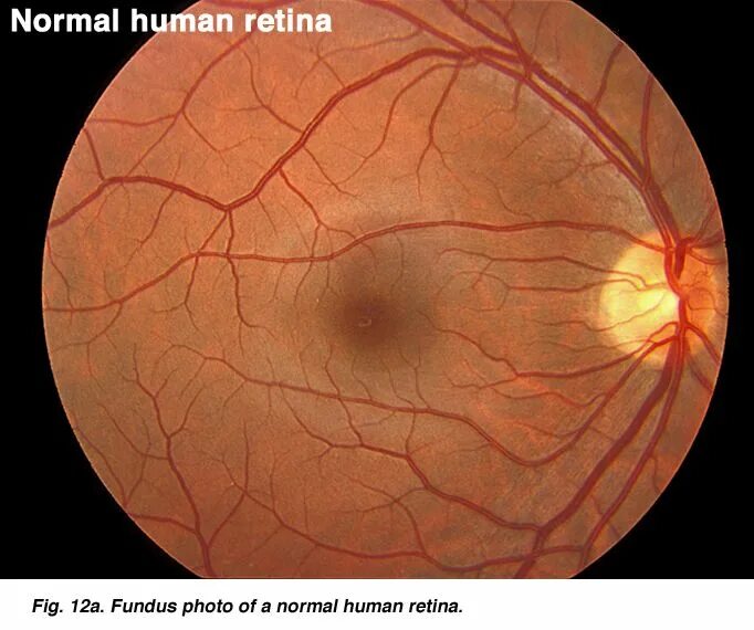 Montagen retinal platina. Montagen retinal platina. Ретиношизис дистрофия сетчатки. Офтальмоскопия диска зрительного нерва. Буллезный ретиношизис.