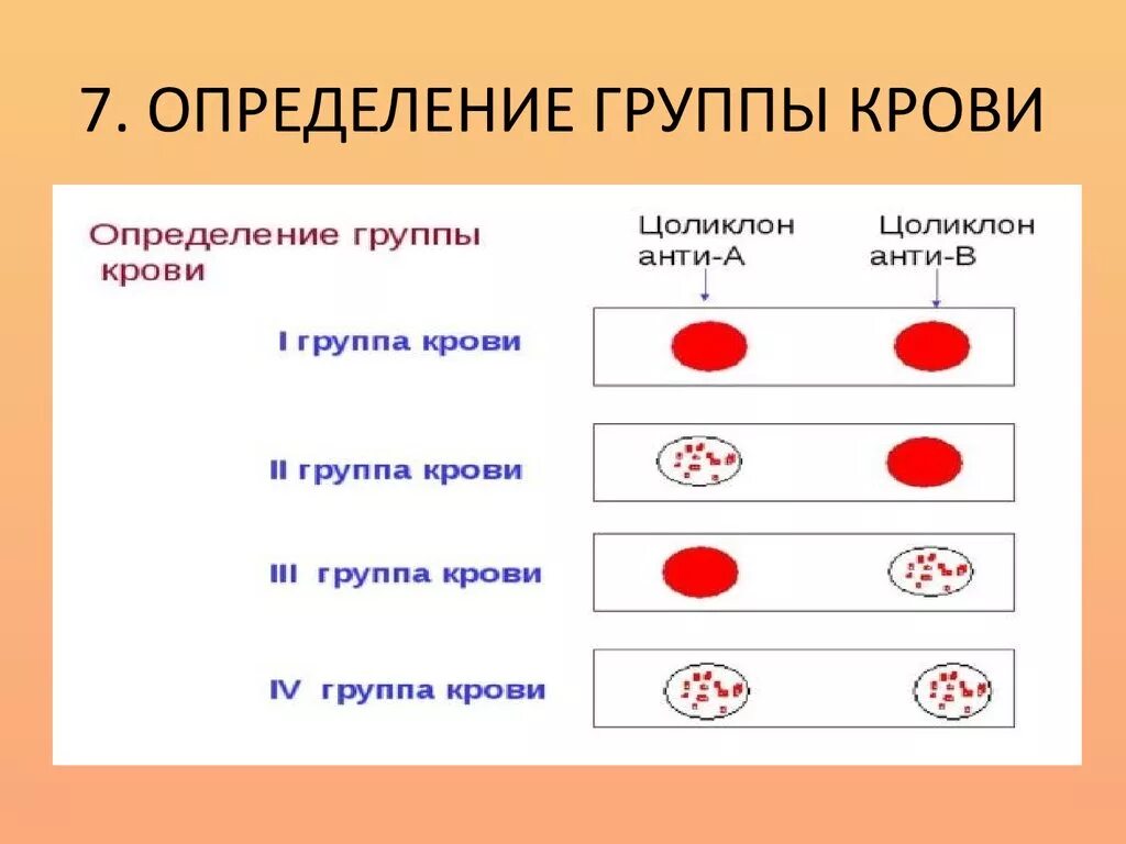 Определите группу крови тест. Определение гр крови цоликлонами алгоритм резус фактор. Определение группы крови по цоликлонам алгоритм. Алгоритм определения резус фактора крови по цоликлонам. Цоликлон группа крови резус.