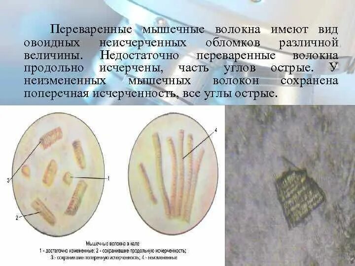 Растительная клетчатка в копрограмме. Микроскопия кала переваренные мышечные волокна. Переваримые мышечные волокна в Кале. Мышечные волокна неизмененные в Кале у взрослого. Копрограмма мышечные волокна с исчерченностью.