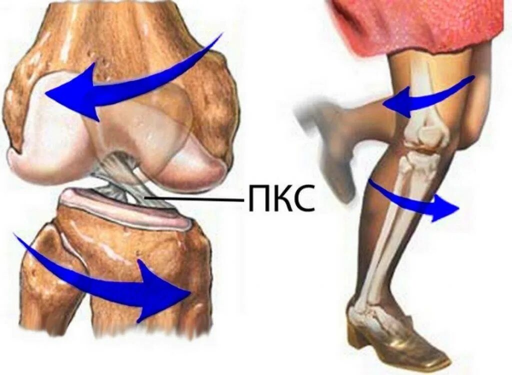 Разрыв ПКС коленного сустава. Разрыв мениска механизм травмы. Растяжение ПКС коленного сустава. Передняя крестообразная связка коленного сустава разрыв.